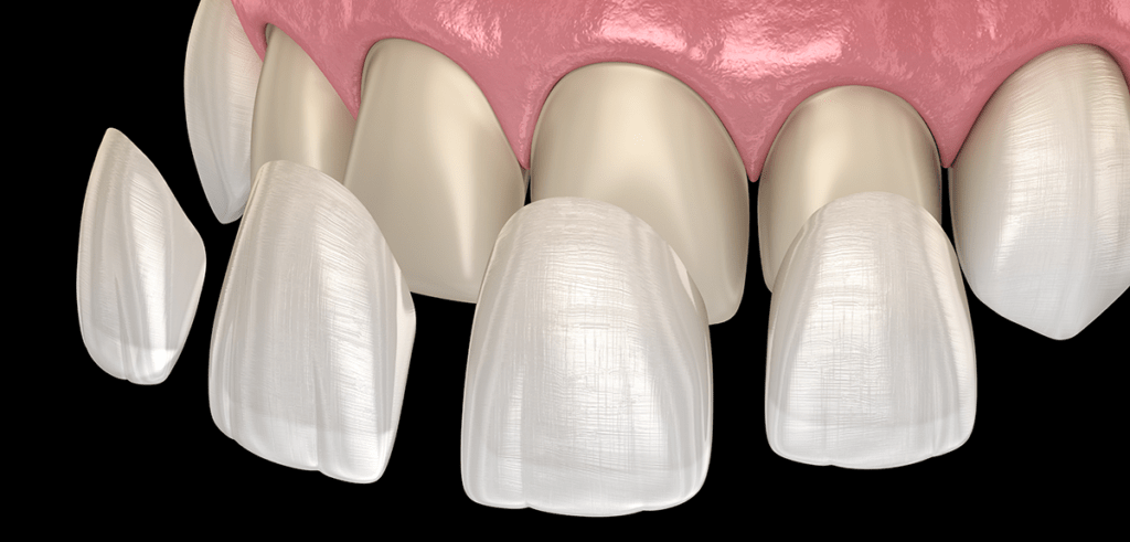 dental veneers illustration